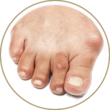 Bunion Treatment in the Cuyahoga County, OH: Beachwood (Woodmere, Orange, Warrensville Heights, Highland Hills, Shaker Heights, Pepper Pike, Moreland Hills, Bedford Heights, MT Pleasant) and Mayfield Heights (Gates Mills, Hunting Valley, Lyndhurst, Willoughby Hills, South Euclid, Chesterland, Wickliffe, Richmond Heights), Lake County, OH: Mentor (Willoughby, Kirtland, Waite Hill, Eastlake, Grand River, Painesville, Lakeline, Concord), and Summit County, OH: Tallmadge (Munroe Falls, Goodyear Heights, Chapel Hill, Arlington, Middlebury, Akron, Brimfield, Kent) areas