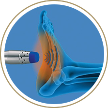 Radial shockwave therapy in the Cuyahoga County, OH: Beachwood (Woodmere, Orange, Warrensville Heights, Highland Hills, Shaker Heights, Pepper Pike, Moreland Hills, Bedford Heights, MT Pleasant) and Mayfield Heights (Gates Mills, Hunting Valley, Lyndhurst, Willoughby Hills, South Euclid, Chesterland, Wickliffe, Richmond Heights), Lake County, OH: Mentor (Willoughby, Kirtland, Waite Hill, Eastlake, Grand River, Painesville, Lakeline, Concord), and Summit County, OH: Tallmadge (Munroe Falls, Goodyear Heights, Chapel Hill, Arlington, Middlebury, Akron, Brimfield, Kent) areas