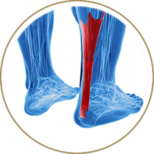 Achilles Tendonitis treatment in the Cuyahoga County, OH: Beachwood (Woodmere, Orange, Warrensville Heights, Highland Hills, Shaker Heights, Pepper Pike, Moreland Hills, Bedford Heights, MT Pleasant) and Mayfield Heights (Gates Mills, Hunting Valley, Lyndhurst, Willoughby Hills, South Euclid, Chesterland, Wickliffe, Richmond Heights), Lake County, OH: Mentor (Willoughby, Kirtland, Waite Hill, Eastlake, Grand River, Painesville, Lakeline, Concord), and Summit County, OH: Tallmadge (Munroe Falls, Goodyear Heights, Chapel Hill, Arlington, Middlebury, Akron, Brimfield, Kent) areas
