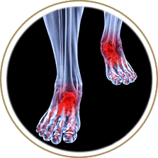 Arthritic foot care treatment in the Cuyahoga County, OH: Beachwood (Woodmere, Orange, Warrensville Heights, Highland Hills, Shaker Heights, Pepper Pike, Moreland Hills, Bedford Heights, MT Pleasant) and Mayfield Heights (Gates Mills, Hunting Valley, Lyndhurst, Willoughby Hills, South Euclid, Chesterland, Wickliffe, Richmond Heights), Lake County, OH: Mentor (Willoughby, Kirtland, Waite Hill, Eastlake, Grand River, Painesville, Lakeline, Concord), and Summit County, OH: Tallmadge (Munroe Falls, Goodyear Heights, Chapel Hill, Arlington, Middlebury, Akron, Brimfield, Kent) areas