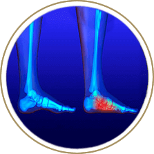 Flat feet treatment in the Cuyahoga County, OH: Beachwood (Woodmere, Orange, Warrensville Heights, Highland Hills, Shaker Heights, Pepper Pike, Moreland Hills, Bedford Heights, MT Pleasant) and Mayfield Heights (Gates Mills, Hunting Valley, Lyndhurst, Willoughby Hills, South Euclid, Chesterland, Wickliffe, Richmond Heights), Lake County, OH: Mentor (Willoughby, Kirtland, Waite Hill, Eastlake, Grand River, Painesville, Lakeline, Concord), and Summit County, OH: Tallmadge (Munroe Falls, Goodyear Heights, Chapel Hill, Arlington, Middlebury, Akron, Brimfield, Kent) areas