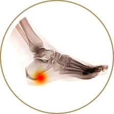 Heel Spurs specialist in the Cuyahoga County, OH: Beachwood (Woodmere, Orange, Warrensville Heights, Highland Hills, Shaker Heights, Pepper Pike, Moreland Hills, Bedford Heights, MT Pleasant) and Mayfield Heights (Gates Mills, Hunting Valley, Lyndhurst, Willoughby Hills, South Euclid, Chesterland, Wickliffe, Richmond Heights), Lake County, OH: Mentor (Willoughby, Kirtland, Waite Hill, Eastlake, Grand River, Painesville, Lakeline, Concord), and Summit County, OH: Tallmadge (Munroe Falls, Goodyear Heights, Chapel Hill, Arlington, Middlebury, Akron, Brimfield, Kent) areas