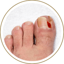 Ingrown toenail specialist in the Cuyahoga County, OH: Beachwood (Woodmere, Orange, Warrensville Heights, Highland Hills, Shaker Heights, Pepper Pike, Moreland Hills, Bedford Heights, MT Pleasant) and Mayfield Heights (Gates Mills, Hunting Valley, Lyndhurst, Willoughby Hills, South Euclid, Chesterland, Wickliffe, Richmond Heights), Lake County, OH: Mentor (Willoughby, Kirtland, Waite Hill, Eastlake, Grand River, Painesville, Lakeline, Concord), and Summit County, OH: Tallmadge (Munroe Falls, Goodyear Heights, Chapel Hill, Arlington, Middlebury, Akron, Brimfield, Kent) areas