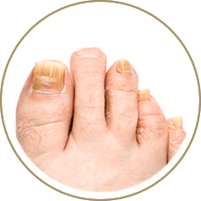 Toenail fungus treatment specialist in the Cuyahoga County, OH: Beachwood (Woodmere, Orange, Warrensville Heights, Highland Hills, Shaker Heights, Pepper Pike, Moreland Hills, Bedford Heights, MT Pleasant) and Mayfield Heights (Gates Mills, Hunting Valley, Lyndhurst, Willoughby Hills, South Euclid, Chesterland, Wickliffe, Richmond Heights), Lake County, OH: Mentor (Willoughby, Kirtland, Waite Hill, Eastlake, Grand River, Painesville, Lakeline, Concord), and Summit County, OH: Tallmadge (Munroe Falls, Goodyear Heights, Chapel Hill, Arlington, Middlebury, Akron, Brimfield, Kent) areas