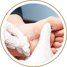 Plantar warts specialist in the Cuyahoga County, OH: Beachwood (Woodmere, Orange, Warrensville Heights, Highland Hills, Shaker Heights, Pepper Pike, Moreland Hills, Bedford Heights, MT Pleasant) and Mayfield Heights (Gates Mills, Hunting Valley, Lyndhurst, Willoughby Hills, South Euclid, Chesterland, Wickliffe, Richmond Heights), Lake County, OH: Mentor (Willoughby, Kirtland, Waite Hill, Eastlake, Grand River, Painesville, Lakeline, Concord), and Summit County, OH: Tallmadge (Munroe Falls, Goodyear Heights, Chapel Hill, Arlington, Middlebury, Akron, Brimfield, Kent) areas