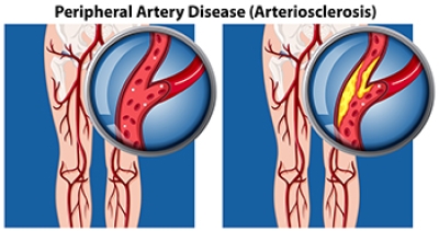 How Peripheral Artery Disease Can Affect the Feet