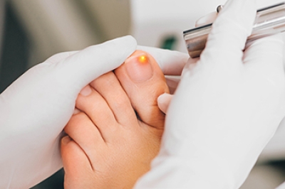 What To Expect During Fungal Toenail Laser Treatment