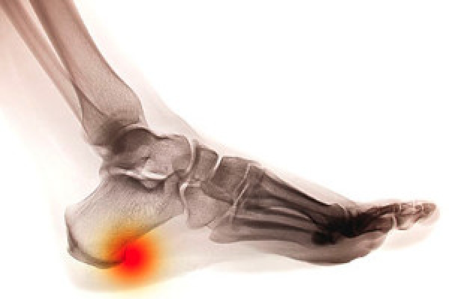 Heel spur | The foot | Biomechanical problems | What We Treat |  Chiropody.co.uk | Leading chiropodist & Podiatrists in Manchester and  Liverpool