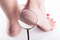 What Can Cause Cracked Heels?